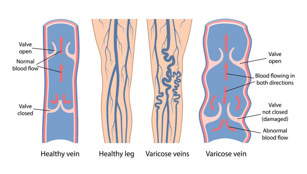 How do you develop varicose veins